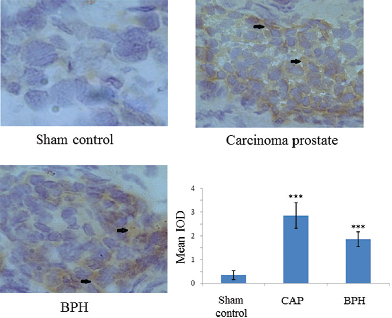 Peripheral-type benzodiazepine receptor (PBR) protein expression by immunohistochemistry (magnification ×200). DAB stain (brown colour) depicts a significant increase in PBR expression in carcinogenic and non-carcinogenic (benign) tumours. Arrows indicate areas of higher expression. In the graph each bar shows the mean±standard deviation of 25 samples, represented as IOD. ***P<0.001 compared to sham control.